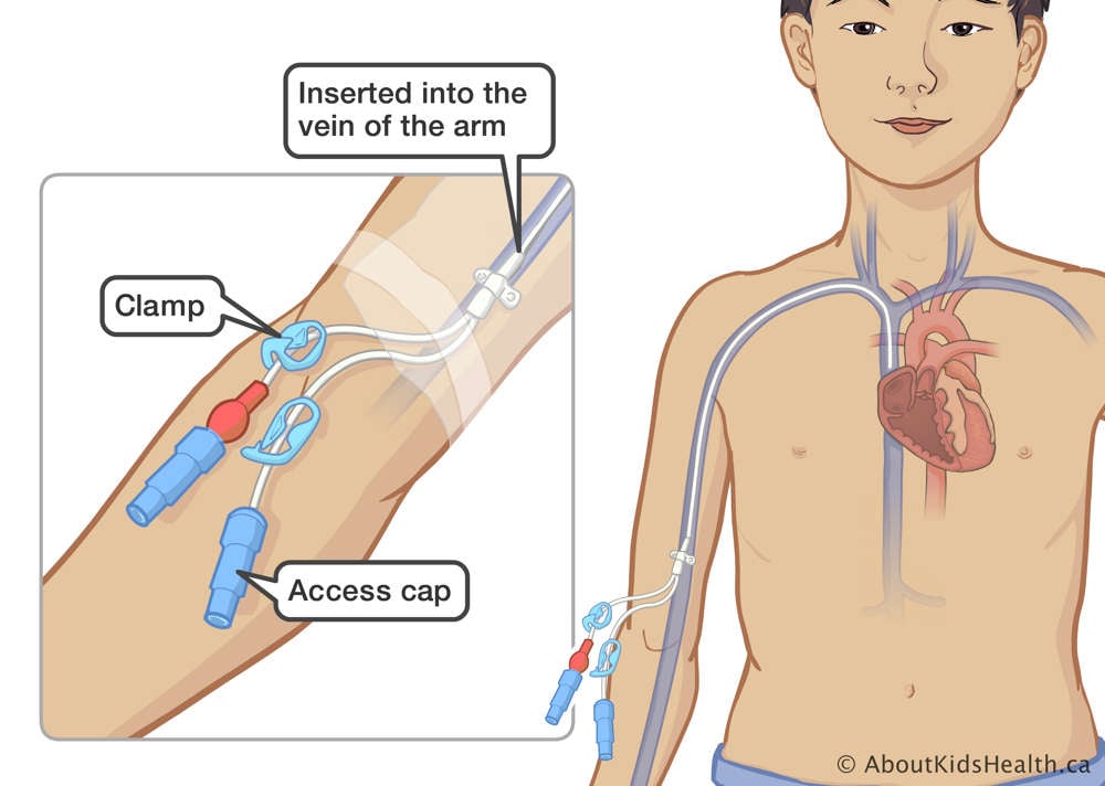 A catheter inserted into the vein of a child&rsquo;s arm with a clamp and access cap on the outside