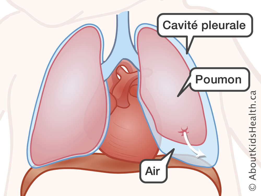 Le poumon, la cavit&eacute; pleurale et l&rsquo;air dans la cavit&eacute;, avec une fl&egrave;che d&rsquo;une tache sur le poumon &agrave; la cavit&eacute; pleurale