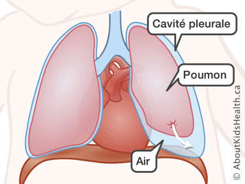Le poumon, la cavité pleurale et l’air dans la cavité, avec une flèche d’une tache sur le poumon à la cavité pleurale