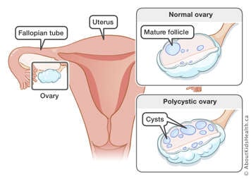 Location of an ovary in relation to the uterus shown with a side by side close up comparison of a normal ovary versus a polycystic ovary typical seen with polycystic ovary syndrome (PCOS)