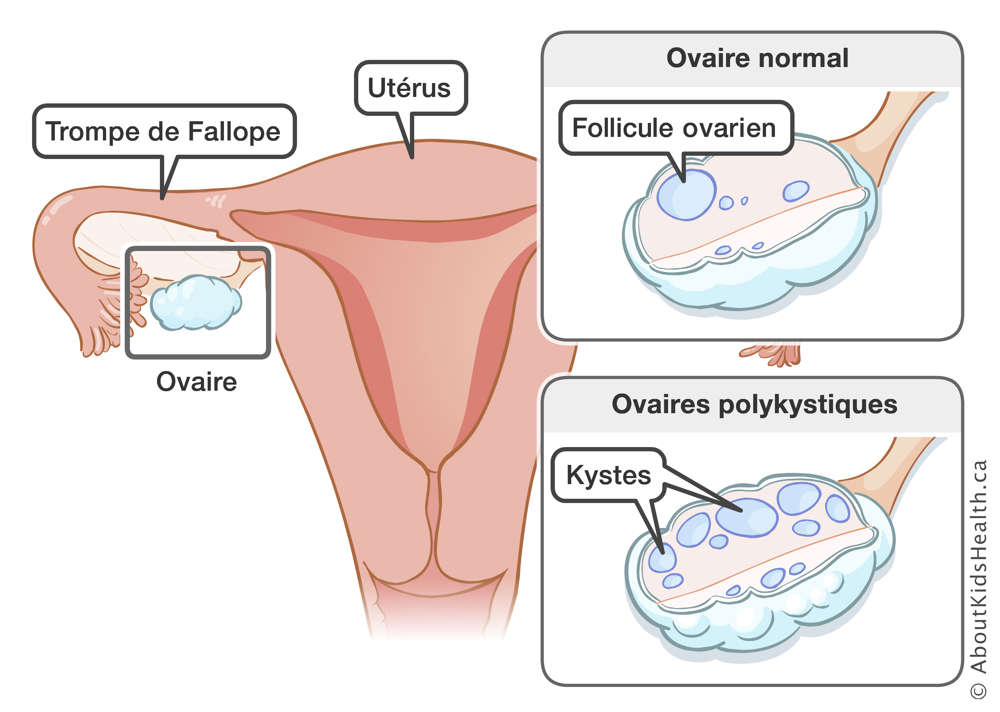 L'utérus, la trompe de Fallope et l'ovaire sont identifiés, aussi qu’un ovaire normal et un ovaire polykystique