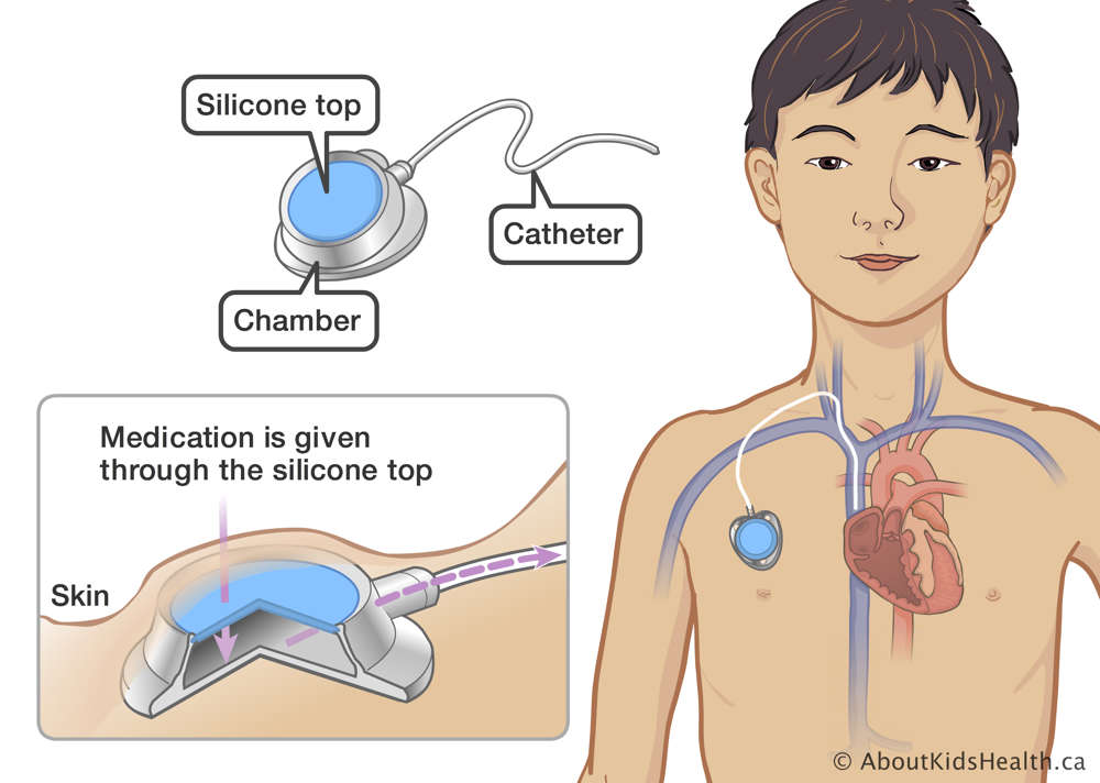 Silicone top, chamber and catheter identified in a port located under the skin and in a large vein in a child&rsquo;s chest
