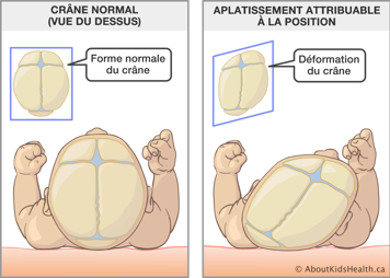 Vue de dessus d’une forme normale du crâne et d’une déformation du crâne à cause de l’aplatissement attribuable à la position