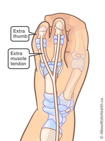 Hand with an extra thumb and extra muscle tendon