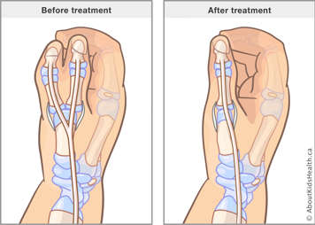 Before and after illustration for surgical removal of an extra thumb with a bony connection