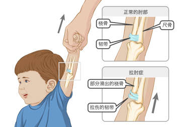 正常肘部的桡骨、尺骨和韧带,以及部分滑脱的桡骨和拉伤的韧带