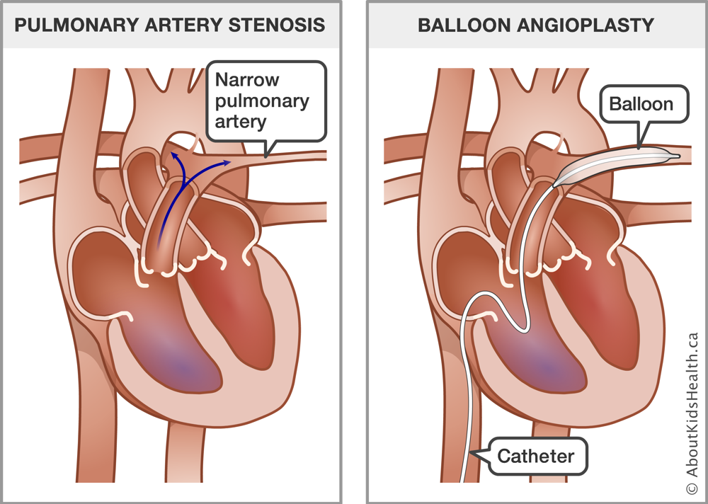Heart with narrow pulmonary artery and heart with catheter and balloon inserted through arteries