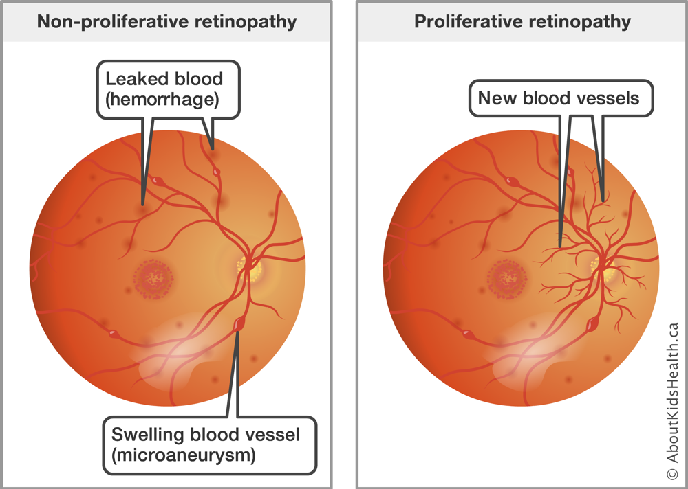 Side by side comparison of the retina of the eye with non-proliferative retinopathy versus proliferative retinopathy