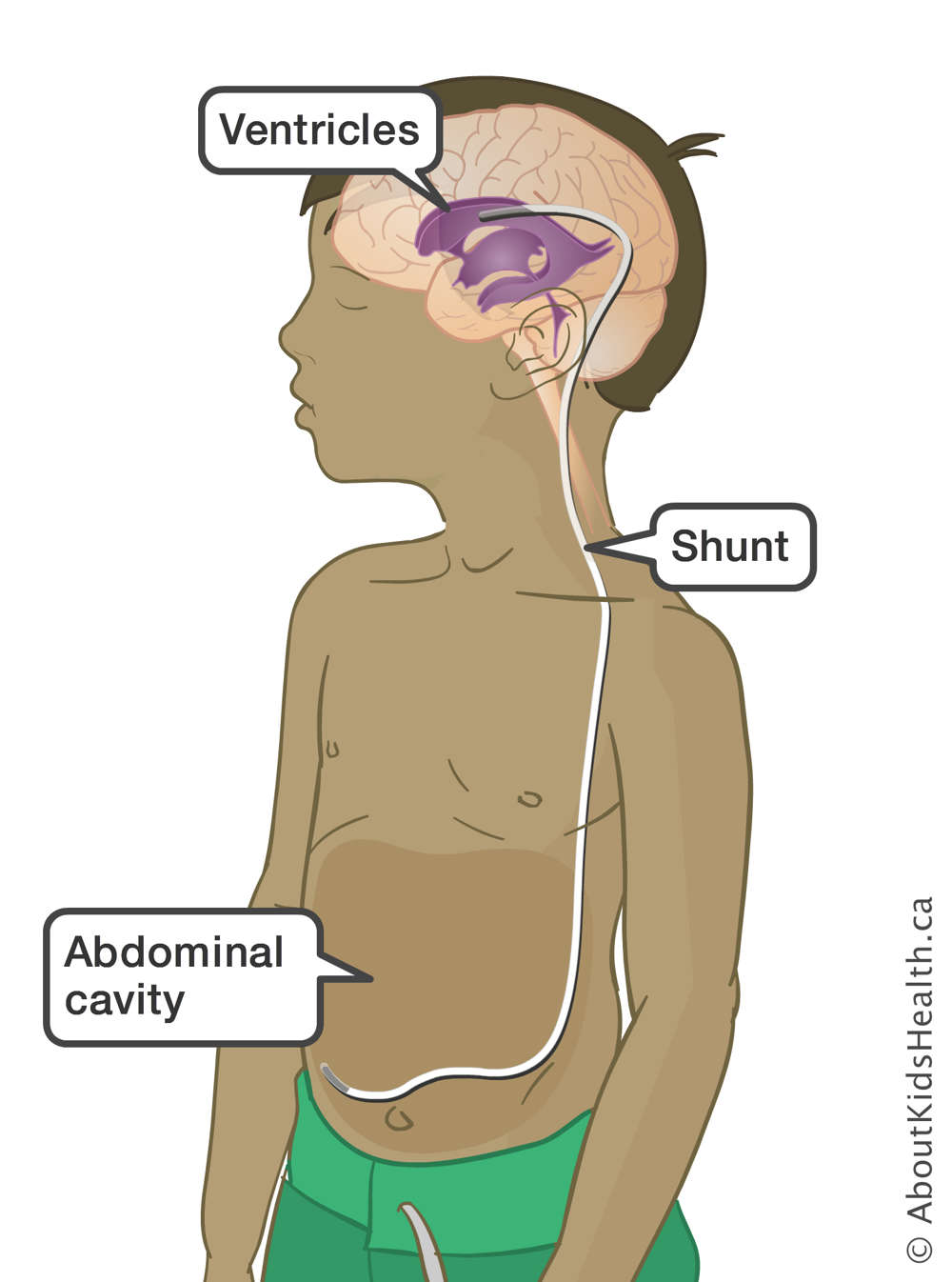 A shunt through the ventricles in the brain and the abdominal cavity of a boy