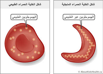 خلية دم حمراء تحتوي على جزيئات هيموجلوبين طبيعية وخلية دم حمراء منجلية تحتوي على جزيئات هيموجلوبين غير طبيعية