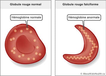 A red blood cell with normal hemoglobin molecules and a sickled red blood cell with abnormal hemoglobin molecules