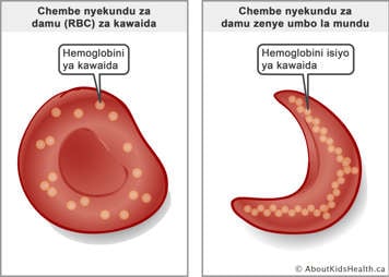 A red blood cell with normal hemoglobin molecules and a sickled red blood cell with abnormal hemoglobin molecules