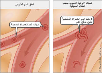 تدفق الدم الطبيعي مع خلايا الدم الحمراء السليمة مقارنة بتدفق الدم المسدود مع خلايا الدم الحمراء المنجلية