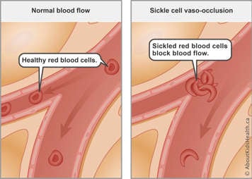 Normal blood flow with healthy red blood cells compared to blocked blood flow from sickled red blood cells