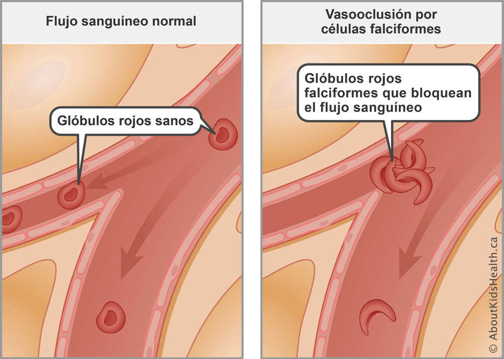Normal blood flow with healthy red blood cells compared to blocked blood flow from sickled red blood cells