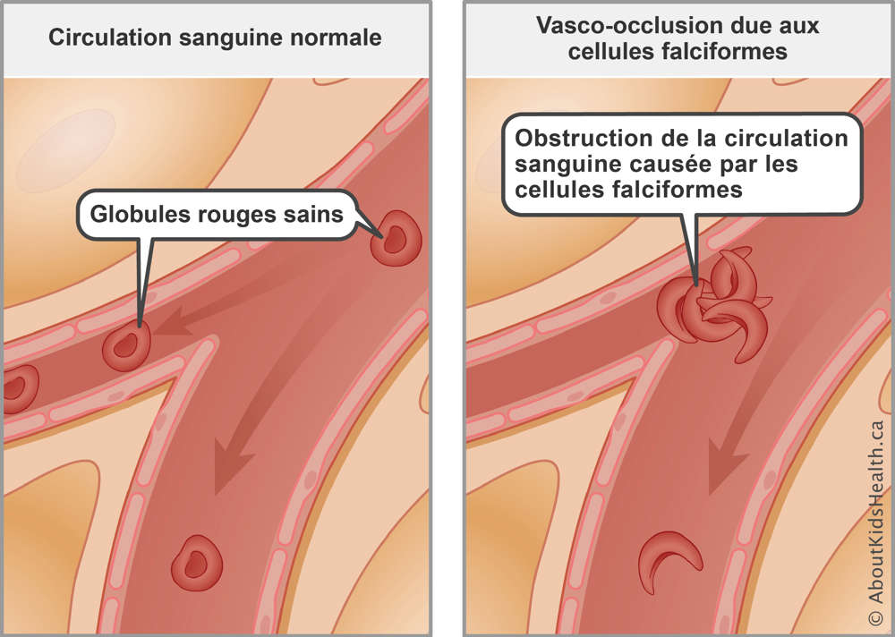 Normal blood flow with healthy red blood cells compared to blocked blood flow from sickled red blood cells
