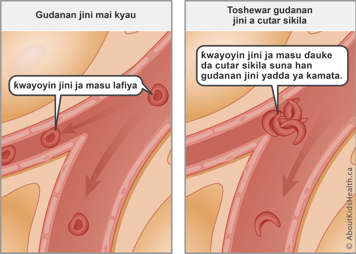 Normal blood flow with healthy red blood cells compared to blocked blood flow from sickled red blood cells
