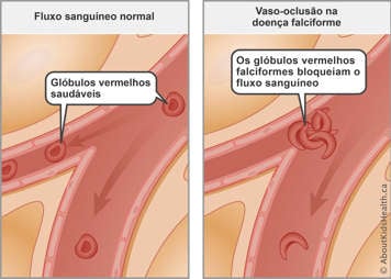 Normal blood flow with healthy red blood cells compared to blocked blood flow from sickled red blood cells