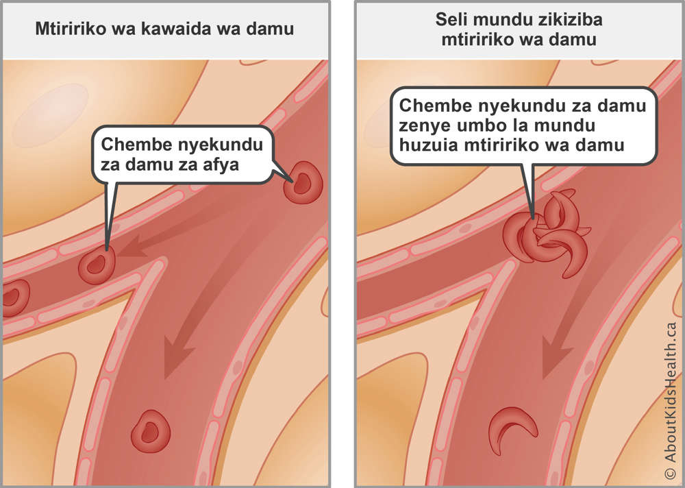 Normal blood flow with healthy red blood cells compared to blocked blood flow from sickled red blood cells