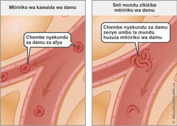 Normal blood flow with healthy red blood cells compared to blocked blood flow from sickled red blood cells