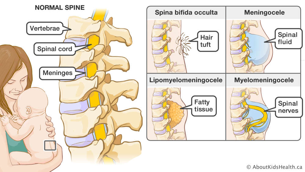 Vertebrae, spinal cord and meninges in normal spine, and illustrations of spines with the four forms of spina bifida