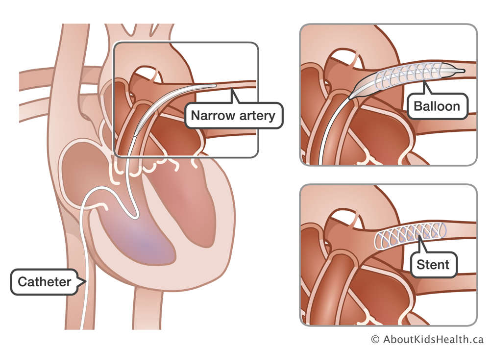 Catheter with balloon and stent inserted into narrow artery of the heart