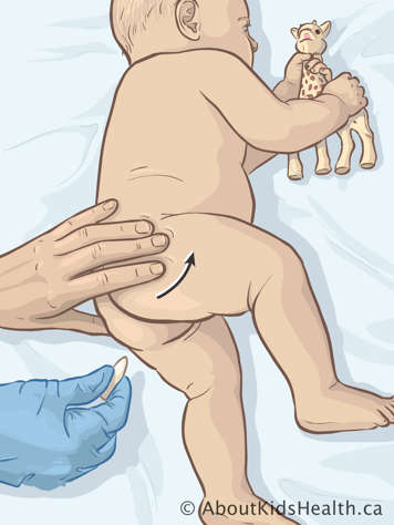 Un suppositoire est tenu près du rectum d’un bébé couché sur son côté avec la jambe levée