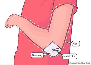 Inside of their arm cast, a child will have a dressing on their elbow with two metal pins coming out
