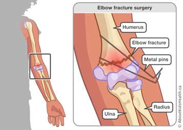 A fracture in the humerus is stabilized with two metal pins