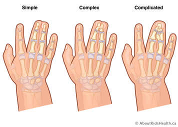 Examples of simple, complex and complicated syndactyly