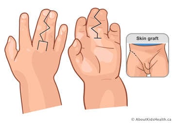 The fingers will be separated using a zig zag pattern