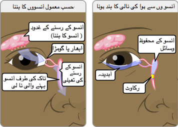 ارمل آنسو پیدا کرنے والی آنکھ اور آنسو والی بند نالی والی آنکھ جو پانی بھری آنکھوں کا سبب ہے
