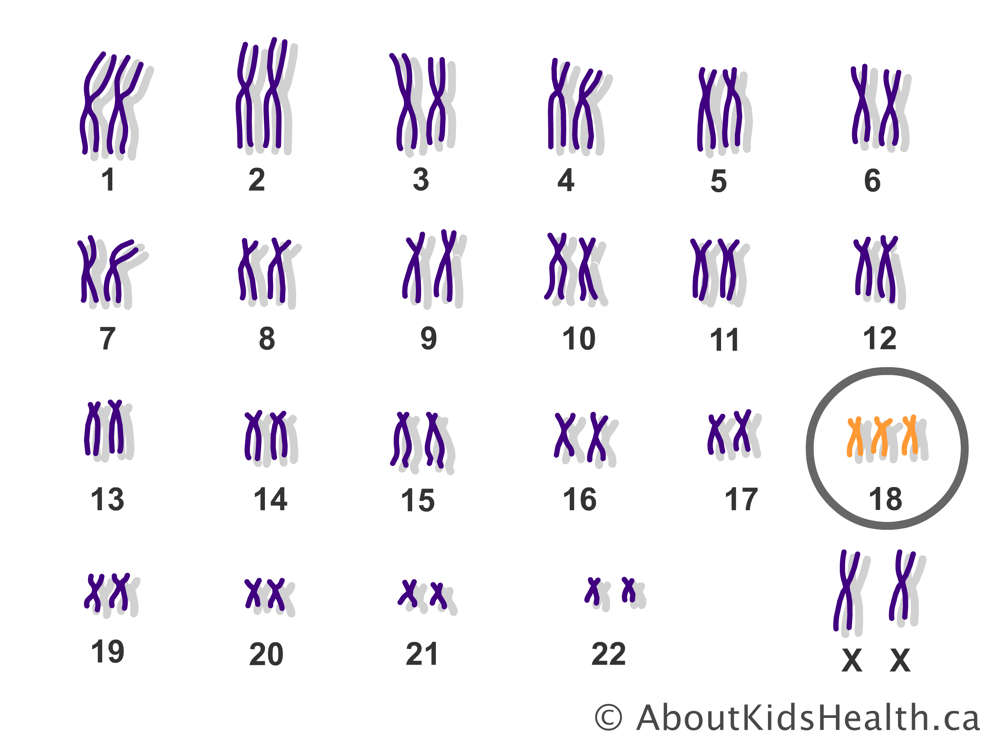 The pairs of chromosomes in a female with an extra copy of chromosome 18