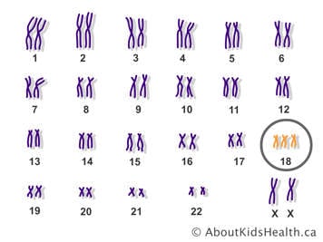 The pairs of chromosomes in a female with an extra copy of chromosome 18