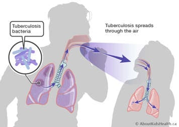 Adult with TB coughing toward child, spreading TB from their lungs, through the air when they cough, into the child's lungs
