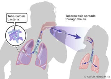 Adult with TB coughing toward child, spreading TB from their lungs, through the air when they cough, into the child's lungs