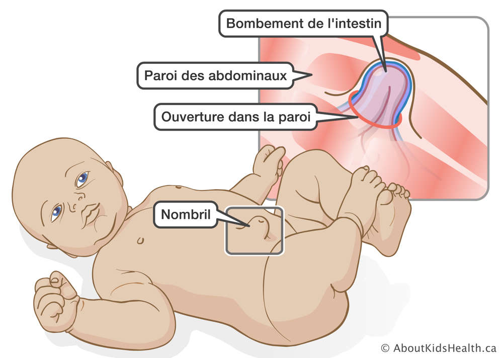 Bombement de l’intestin à travers l’ouverture dans la paroi des abdominaux s’un bébé