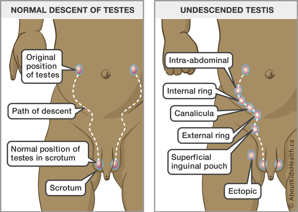 Path of normal descent of testes and the path and potential sites of undescended testes between the abdomen and scrotum