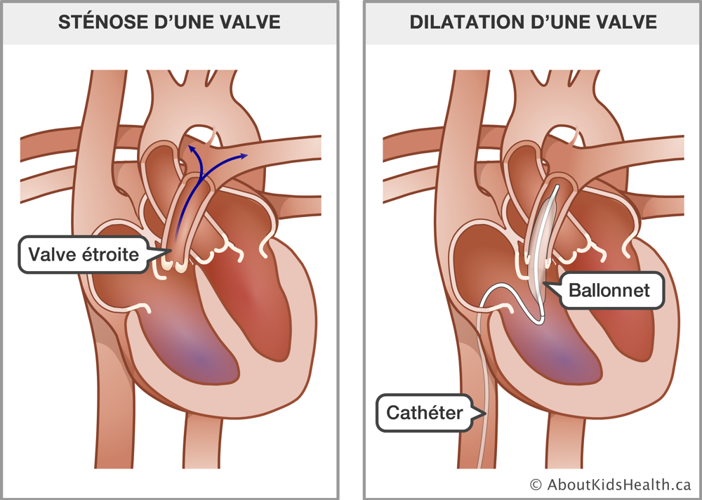 Illustration de la sténose d’une valve et de la dilation d’une valve