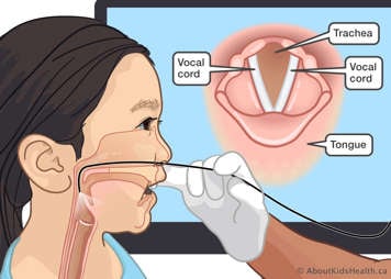 Medical illustration of a gloved hand passing thin tube through a child's nose into the throat to see vocal cords and trachea