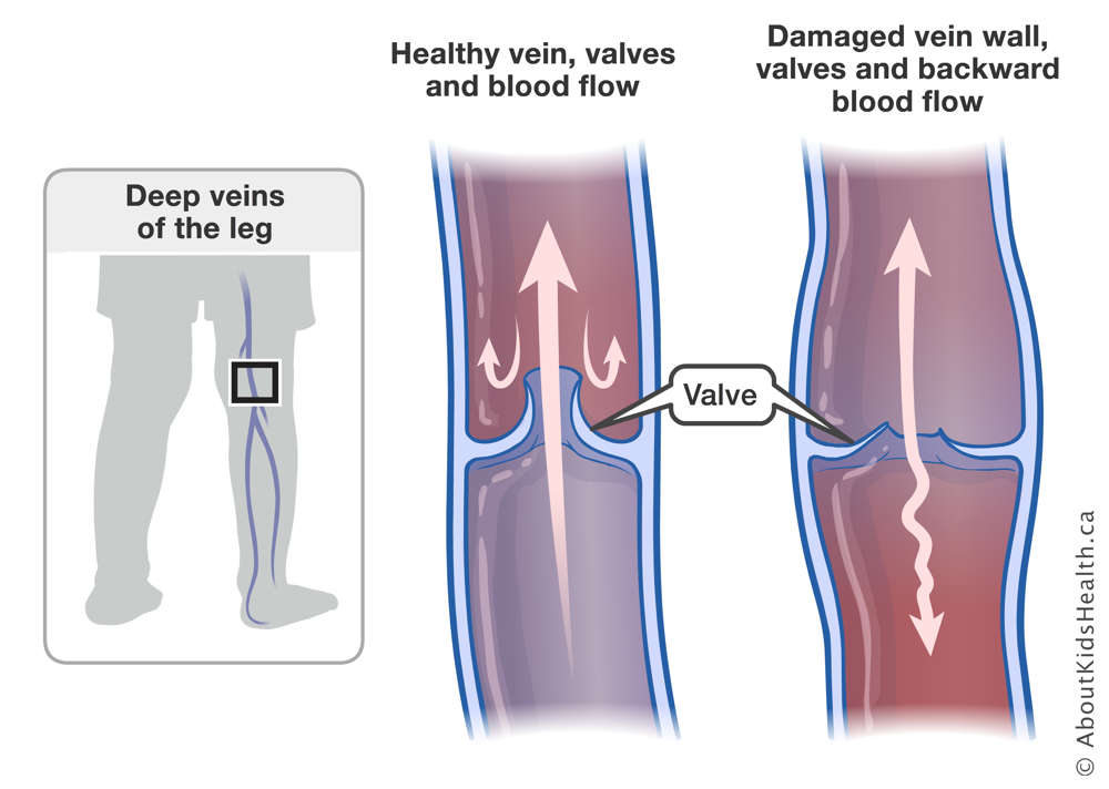 Normal blood flow in healthy vein and valves in the leg and backward blood flow in damaged vein wall and valves