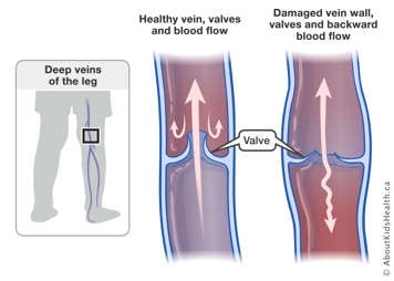 Normal blood flow in healthy vein and valves in the leg and backward blood flow in damaged vein wall and valves