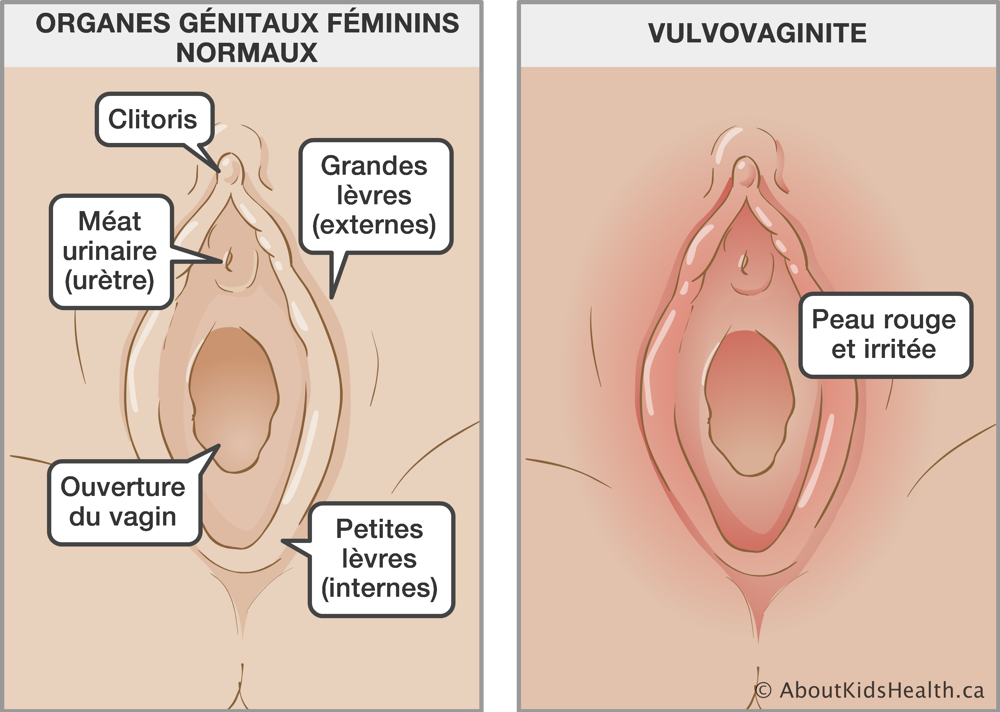 Organes génitaux féminins normaux et organes génitaux féminin avec la peau rouge et irritée