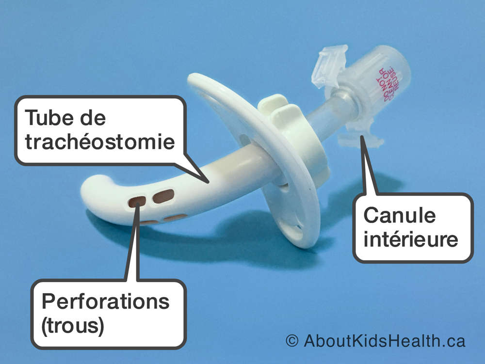 Les parties d’un tube de trachéostomie avec perforations