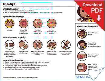 Clickable thumbnail of the impetigo at a glance handout
