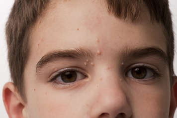 child with bumps caused by molluscum contagiosum on their face