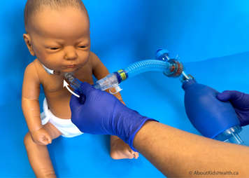 LVR bag being attached to the tracheostomy using the tracheostomy adaptor