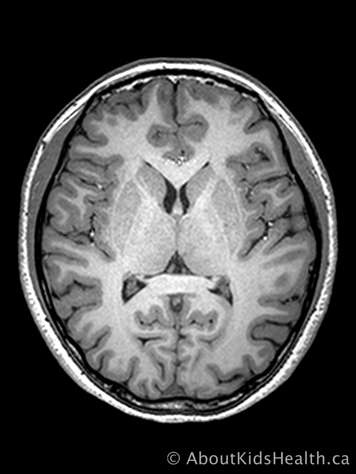 MRI scan of the brain