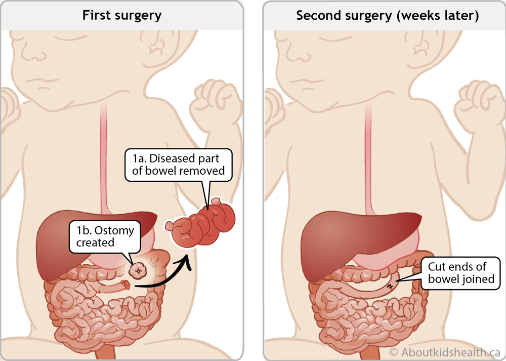 Removing diseased part of bowel and creating ostomy in first surgery and joining cut ends of bowel in second surgery