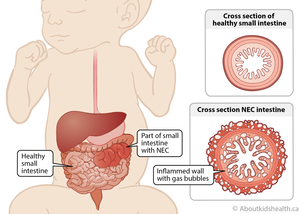 Cross section of healthy small intestine compared to cross section of NEC intestine showing inflamed wall with gas bubbles